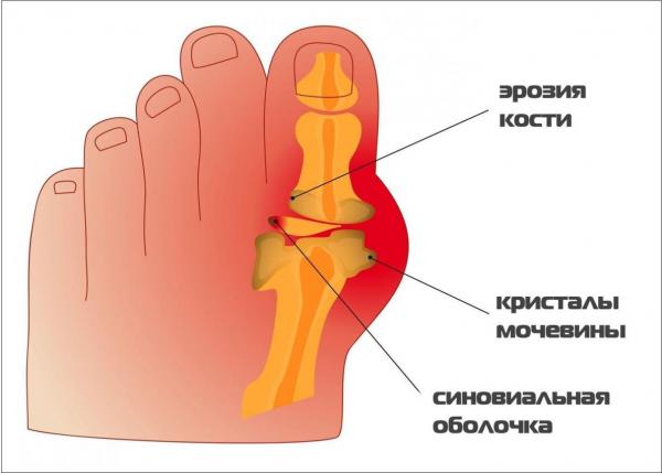 О подагре и способах ее лечения с точки зрения современной медицины